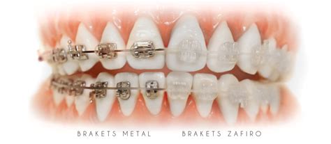 brackets zafiro o metalicos|brackets de zafiro metal.